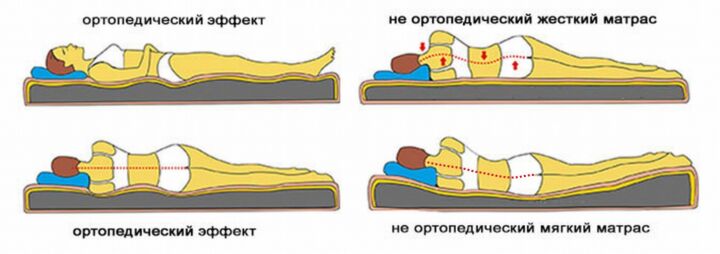 Положение позвоночника с ортопедическим матрасом и другими типами матрасов